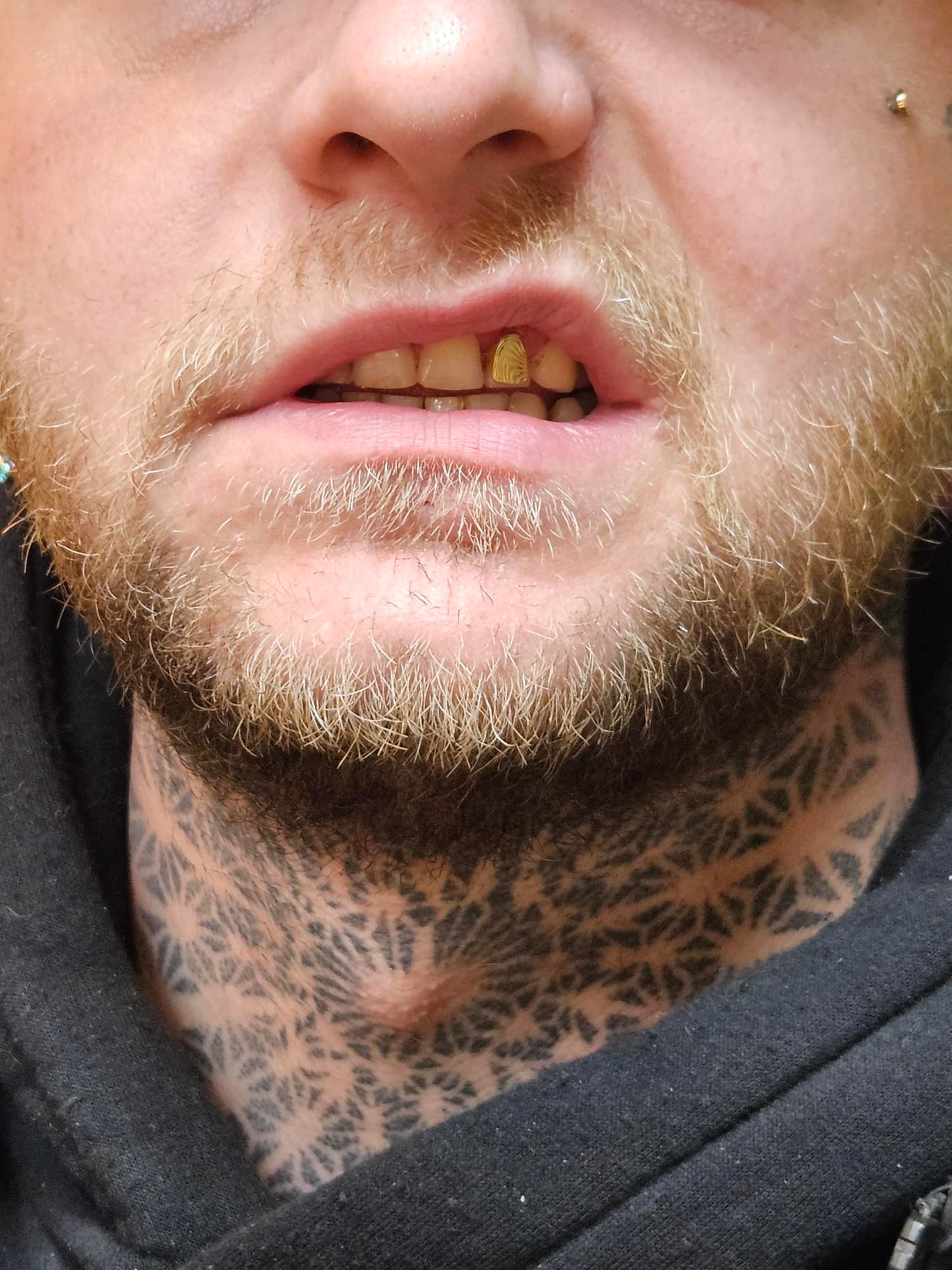 Tooth gem resultaat 5